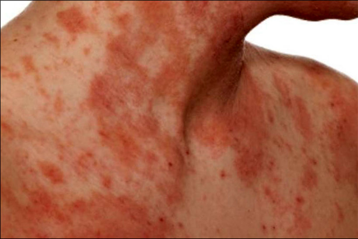 بیماری اگزما