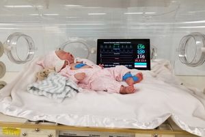 بازگشت به زندگی نوزادی در قشم پس از ۶ بار احیای قلبی–ریوی