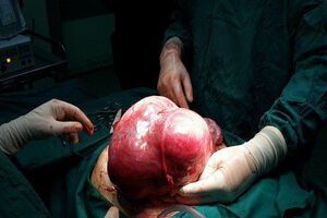 خارج شدن توده پنج کیلویی از شکم دختر ۱۳ ساله در کرمانشاه