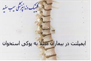 ایمپلنت دندان و پوکی استخوان