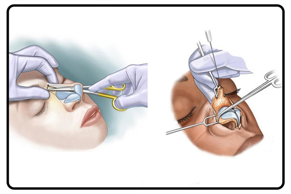 جراحی بینی1