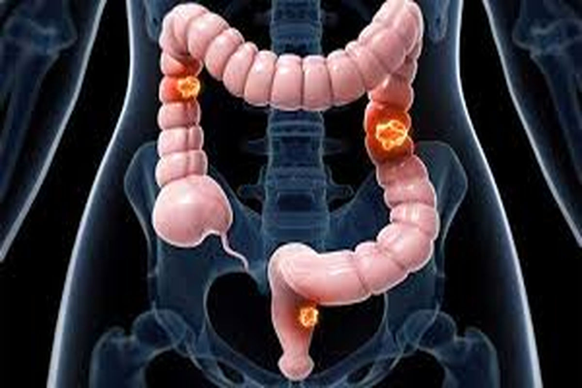 سرطان روده بزرگ