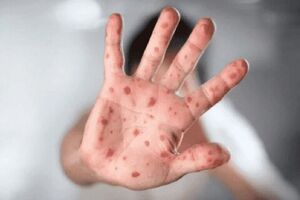 شیوع انسانی آبله میمونی نگران کننده است